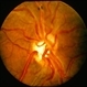 Racemose Hemangioma